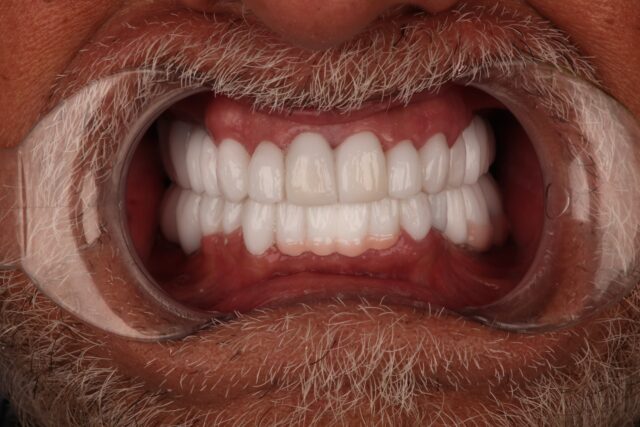 smilling-man-showing-teeth-after-implant