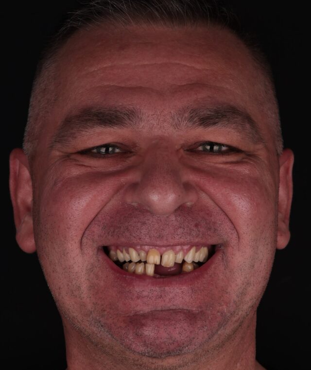man-smilling-with-missing-teeth.jpg