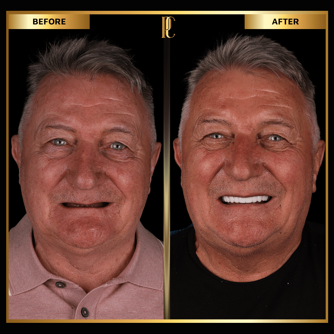 before-and-after-of-man-smiling-with-all-on-4-dental-implants.jpg