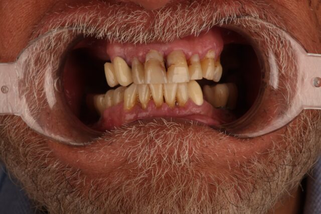 smilling-man-showing-teeth-before-implant
