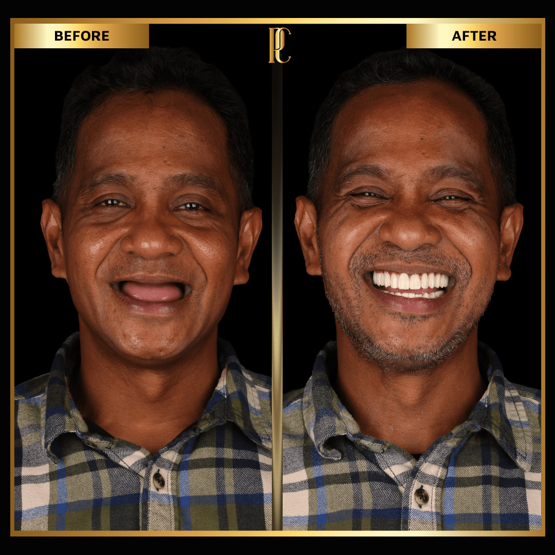 man-smiling-with-all-on-6-dental-implants.jpg