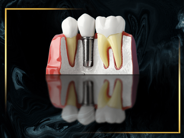 prostethic-view-of-teeth-roots-and-dental-implant