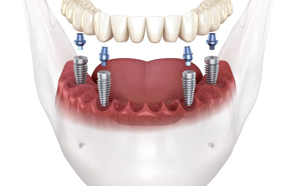 All on 4 Dental Implants: All you need to know