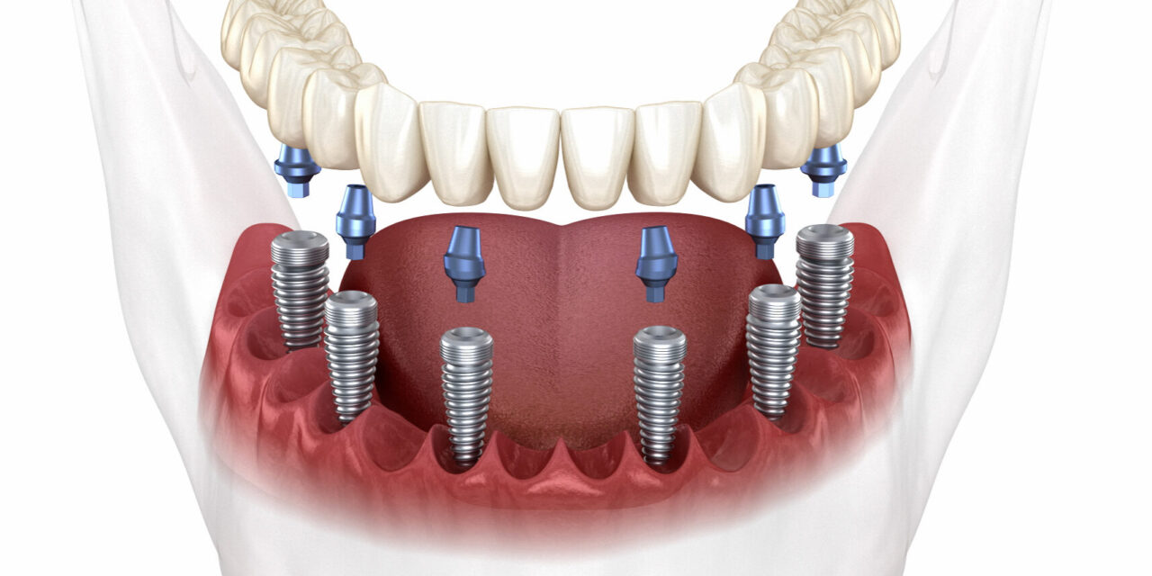 What is All on 6 Dental Implants Treatment | 2024