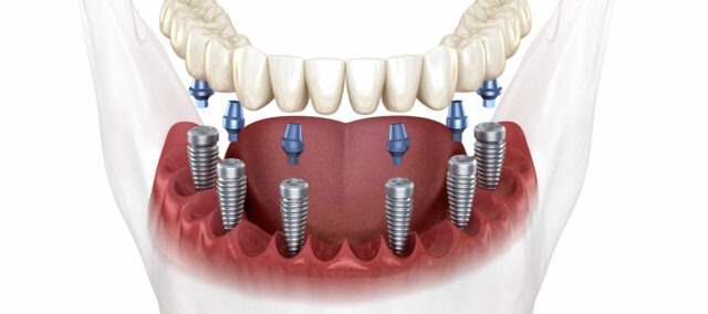 all-on-6-dental-implants.jpg