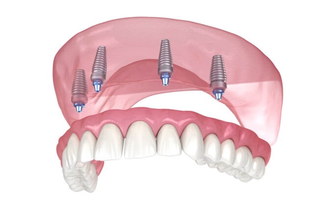 an-illustration-of-all-on-4-dental-implants-with-full-arch-upper-jaw.jpg