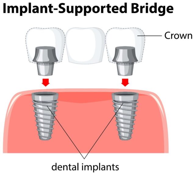 two-dental-implant-in-gums-supporting-bridge-of-three-zirconium-crowns