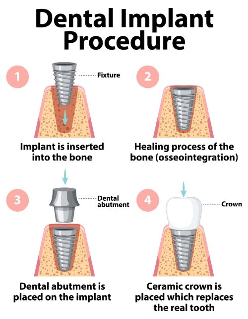 dental-implant-procedure-white-background.jpg