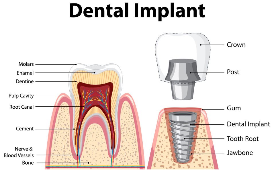 Dental Implants: All You Need To Know | 2024