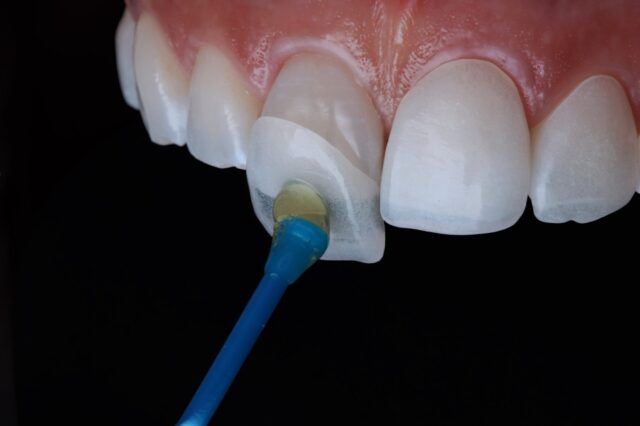 application-of-porcelain-veneers-on-tooth-enamel.jpg