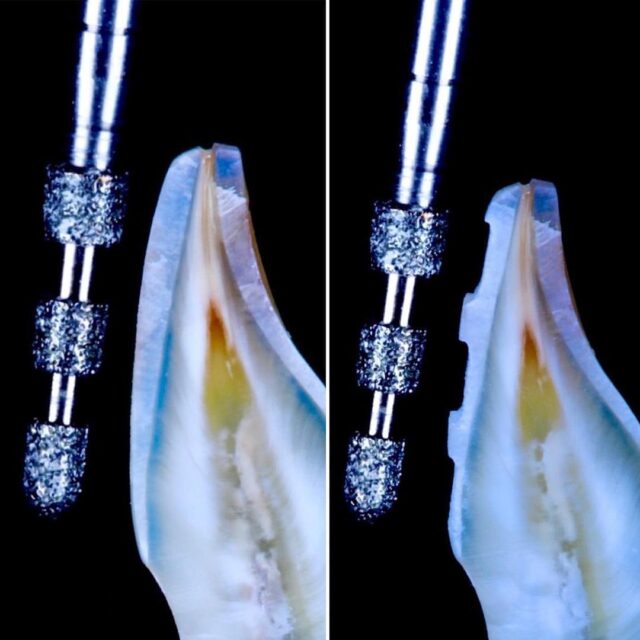 ultra-close-up-photo-of-tooth-enamel-preparation-for-porcelain-veneers