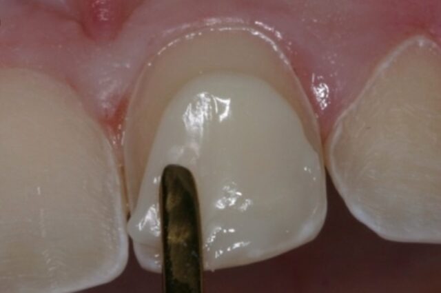 applying-composite-resin-to-teeth