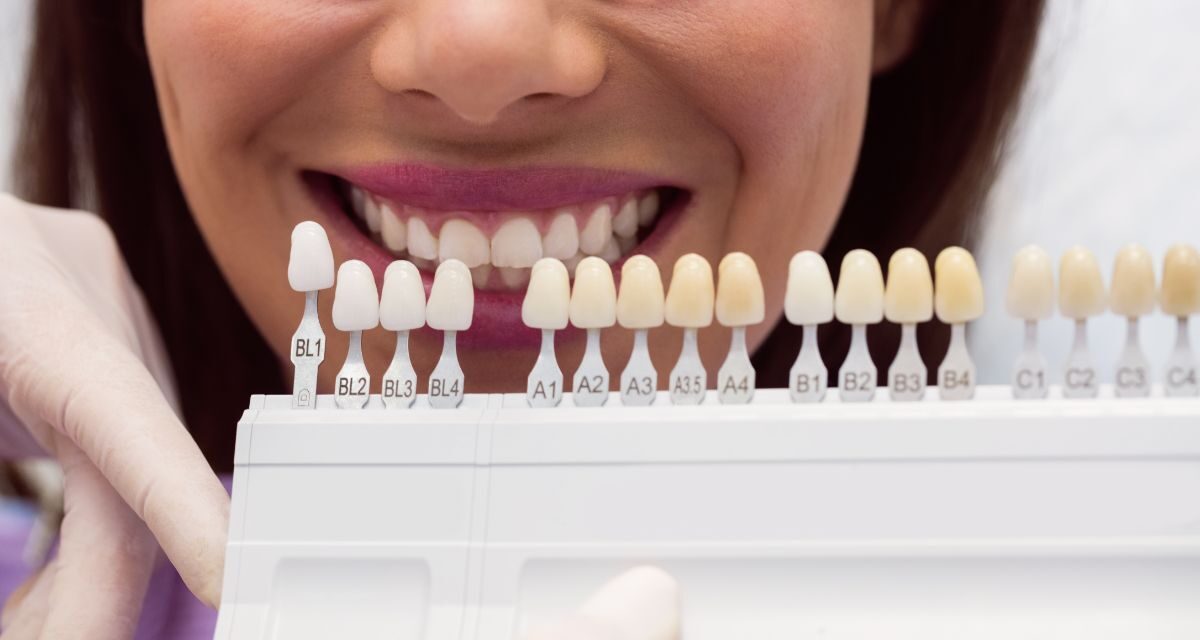 Composite veneers: All you need to know