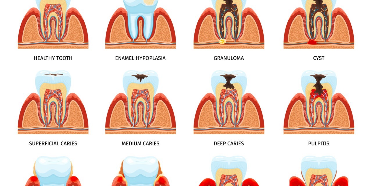  Dental Problems and Tooth Diseases: Causes, Prevention and Treatments