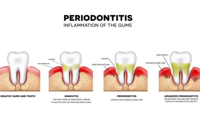 periodontitis-bleeding-gums-diseases.jpg