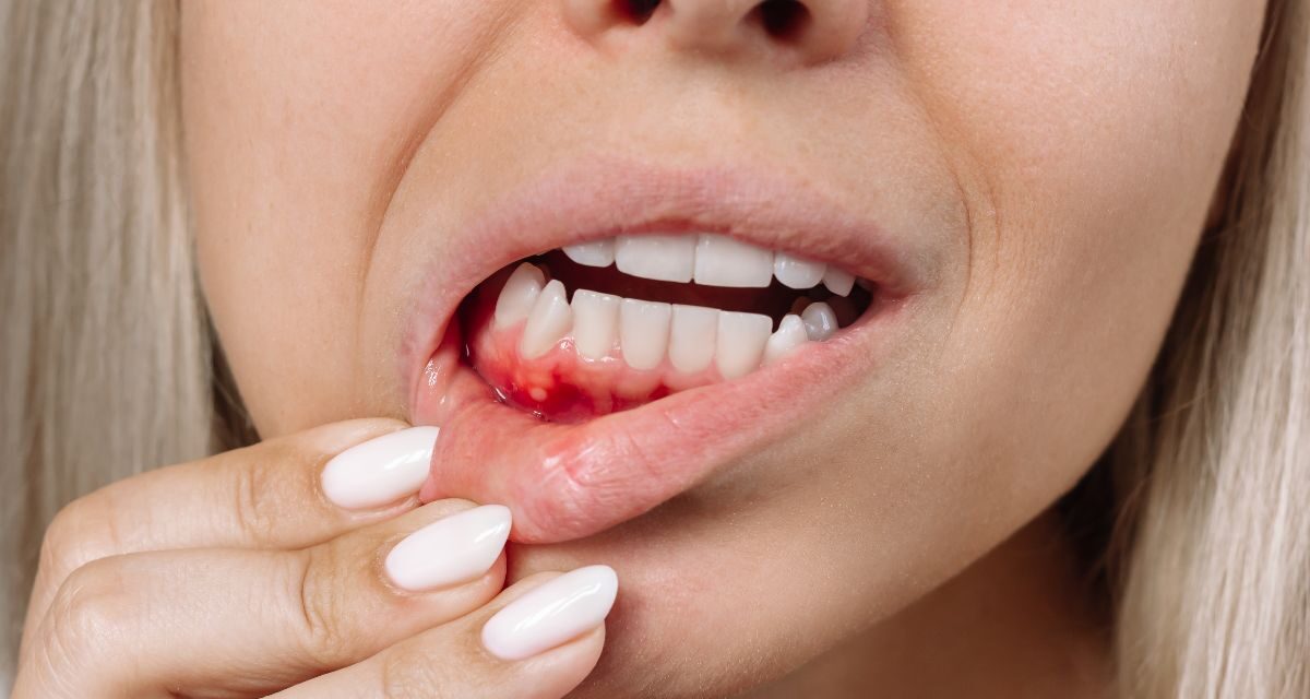 Diş Eti Kanaması: Neden Tehlikelidir ve Ne Yapmalısınız?
