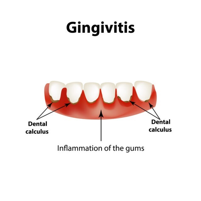 gingivitis-gum-disease-explanation.jpg