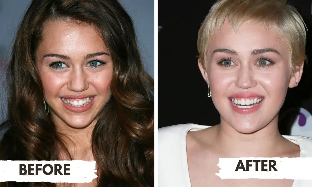 miley-cyrus-teeth-before-after-1