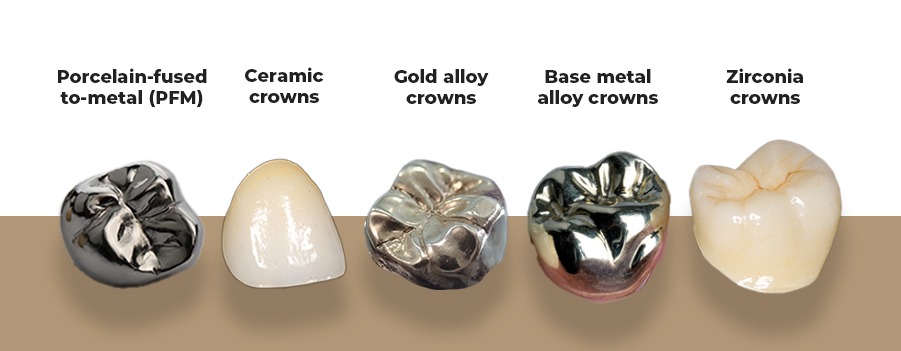 Dental Crowns: Types, Costs and Benefits