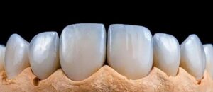 porcelain-crowns-image.jpg