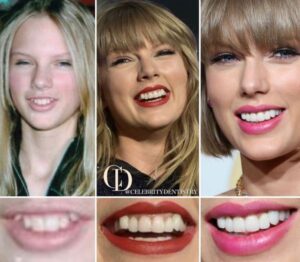 taylor-swift-smile-before-and-after
