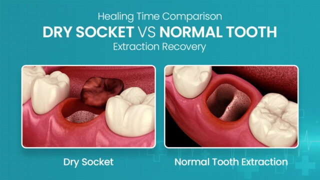 dry-socket-smoking-after-tooth-extraction