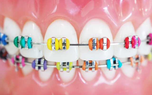 braces-colors-types.jpg