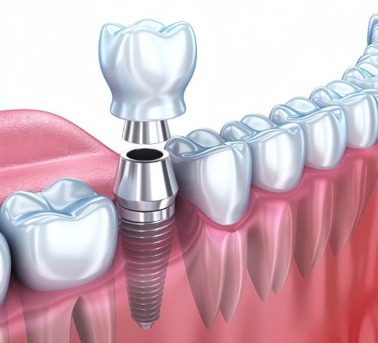 Get Affordable Dental Implants in Turkey Today