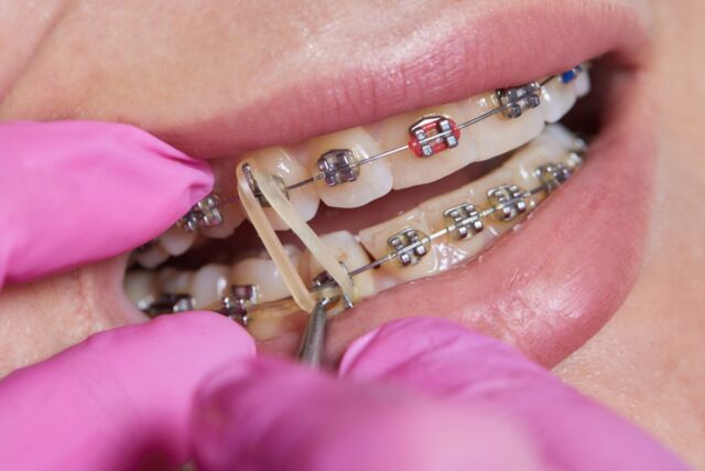 braces-vs-invisalign-image.jpg