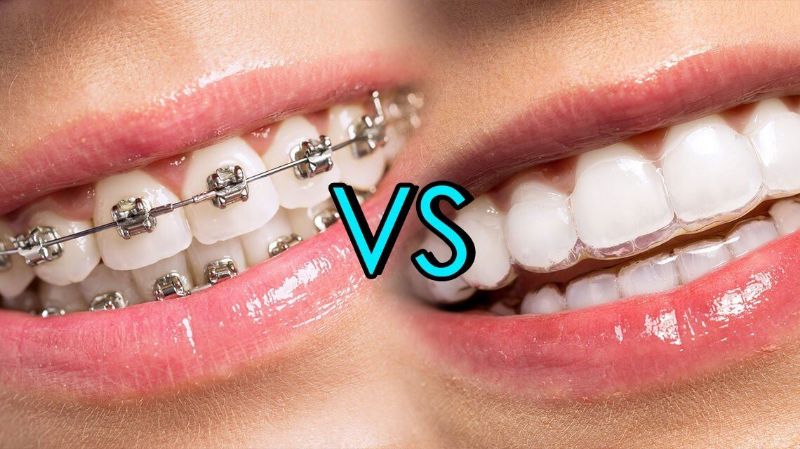 Invisalign Vs Braces, Which is Better?