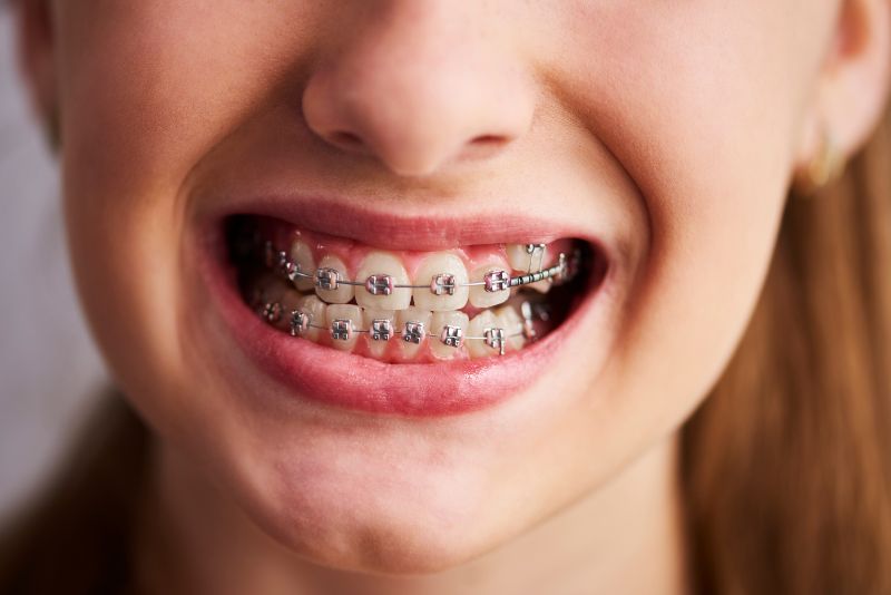 Adult Braces: Everything You Need to Know