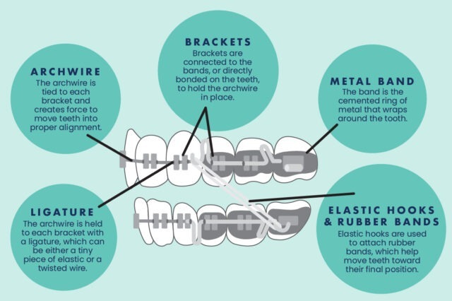 parts-of-adult-braces.jpg