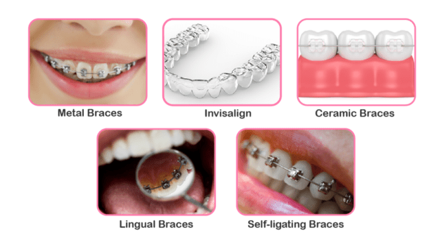 types-of-brace.jpg