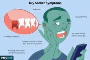 what-is-a-dry-socket-