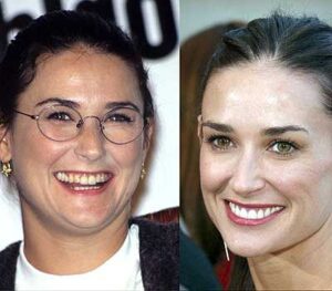 Demi-Moore-smile-before-after-veneers.jpg