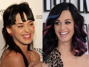Katy-Perry-teeth-before-after-veneers.jpg