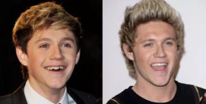 Niall-Horan-teeth-with-veneers-before-after.jpg