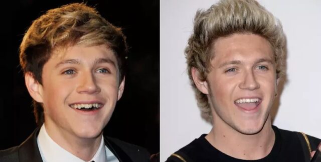 Niall-Horan-teeth-before-after.jpg