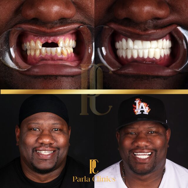 man-smiling-showing-before-and-after-of-teeth-done-in-turkey.jpg