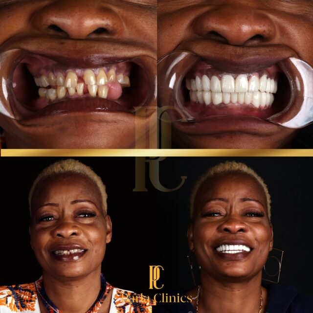 woman-smiling-showing-before-and-after-of-teeth-done-in-turkey.jpg