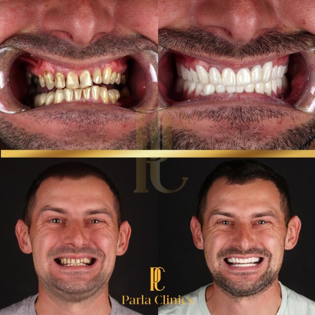 man-smiling-showing-before-and-after-of-teeth-done-in-turkey.jpg