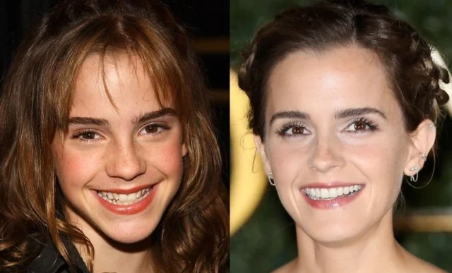 emma-watson-teeth-veneer.jpg