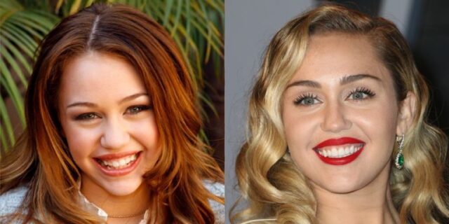 miley-cyrus-teeth-before-after-celebs-with-veneers.jpg