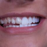 types-of-veneers.jpg