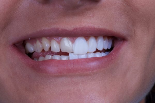 Types of Veneers: Which One is Best for You?