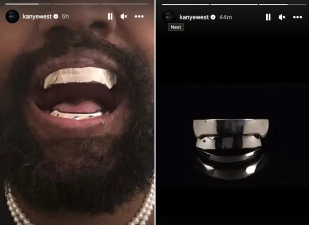 Kanye West Teeth: The Real Story Behind the Trend