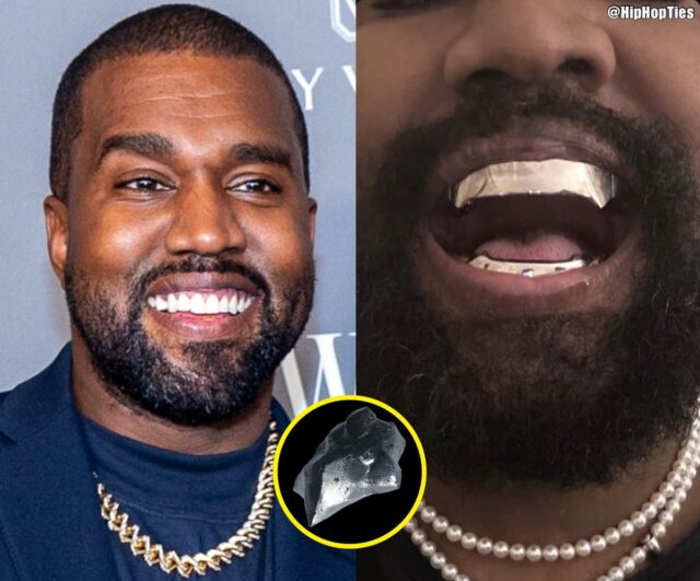 Kanye West Teeth: The Real Story Behind the Trend - Parla Clinics