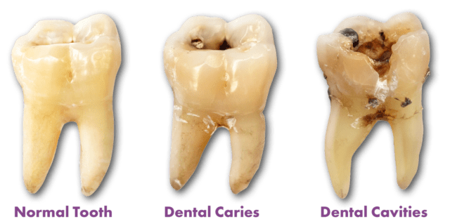 stages-of-tooth-cavity.jpg