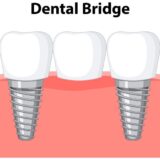 tooth-being-replaced-by-bridge