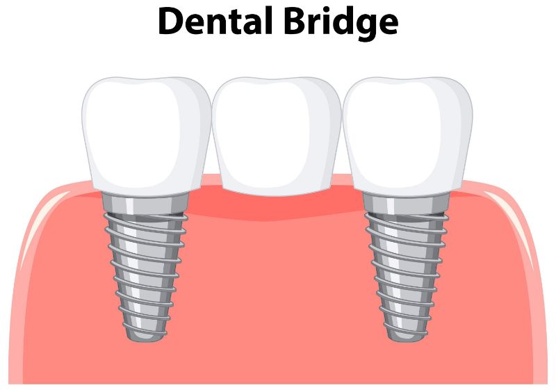 What is a Dental Bridge? All there is to know